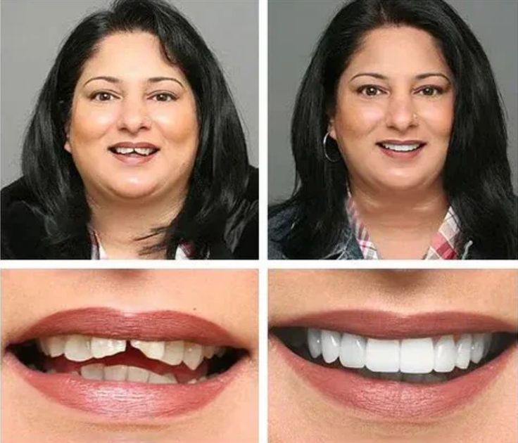 Snap-On Instant Perfect Smile – Comfort Fit Teeth Veneers (Men & Women)✨