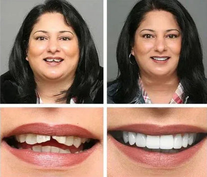 Snap-On Veneers – Instant Perfect Smile Teethñ