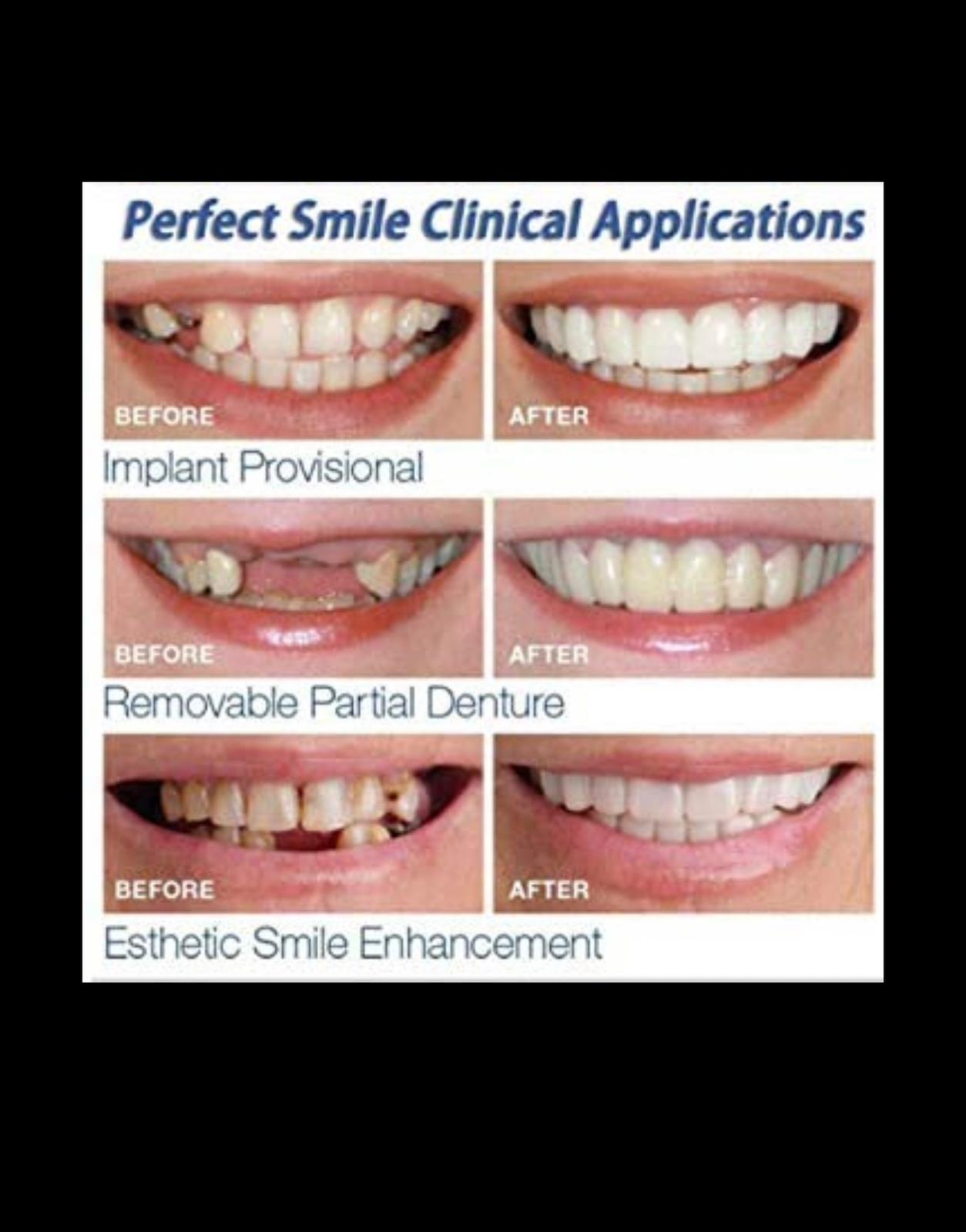 Snap-On Veneers – Instant Perfect Smile Teethñ